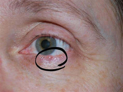 Skin Cancer On Lower Eyelid