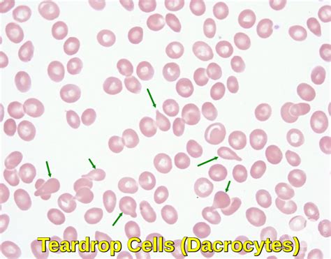 Primary Myelofibrosis - Ask Hematologist | Understand Hematology