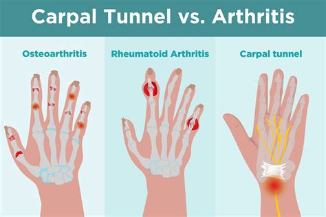 Osteoarthritis & Rheumatoid Arthritis of the Wrist | USASC & Orthopedics