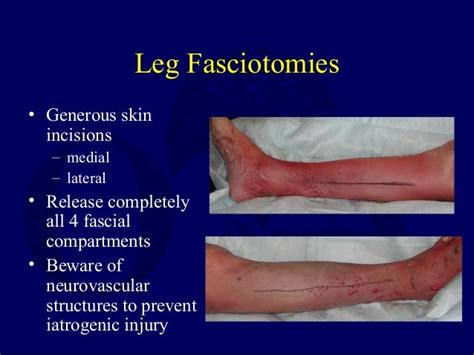 G04 compartment syndrome