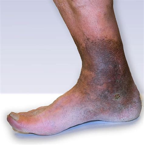 Chronic Venous Insufficiency - The Foot Force Podiatry