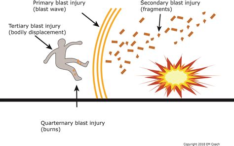 Blast Injury Types, Signs, Symptoms, Diagnosis Treatment, 54% OFF