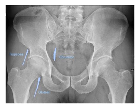 Normal Pelvis X Ray