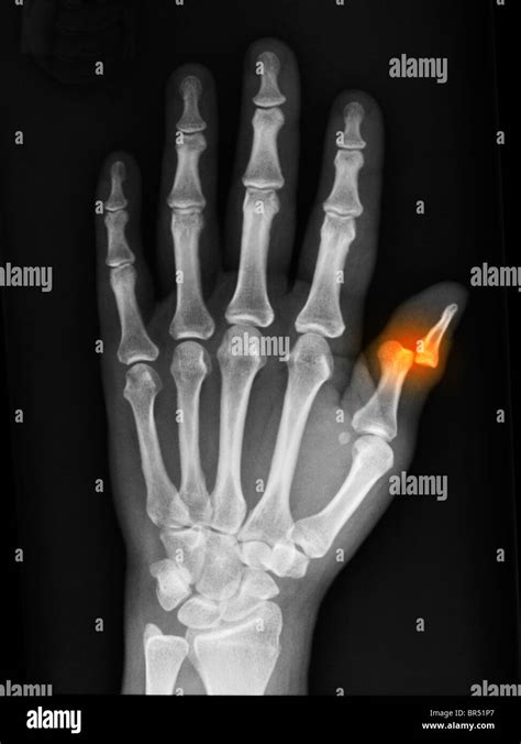 Distal phalanx of thumb hi-res stock photography and images - Alamy