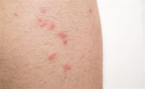 Bed Bug Bite: What Are the Symptoms of an Allergic Reaction? | Healthtian