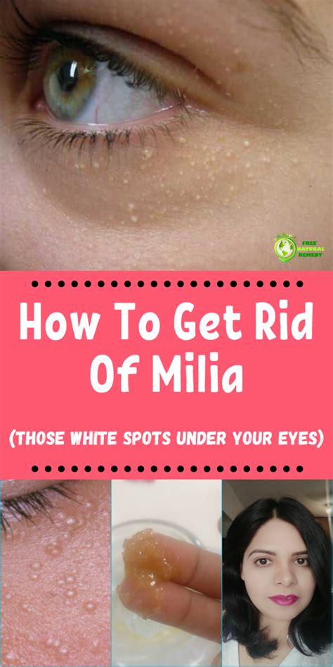 How To Get Rid Of Milia (Those White Spots Under Your Eyes)! | Home ...