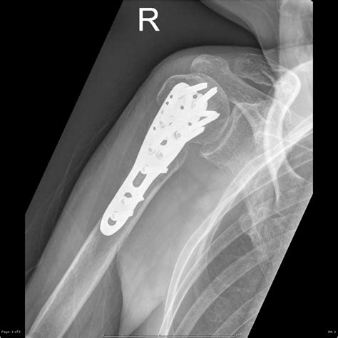 Proximal Humerus Surgical Neck Fracture