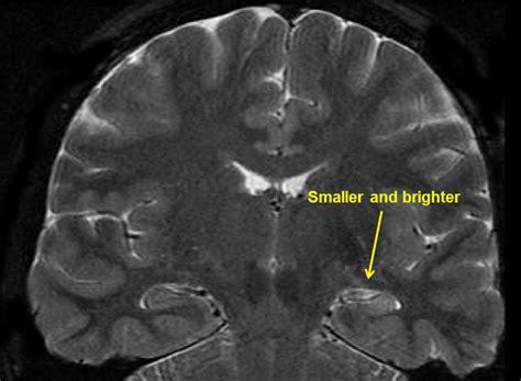 Temporal Lobe Epilepsy (TLE) | Epilepsy Foundation