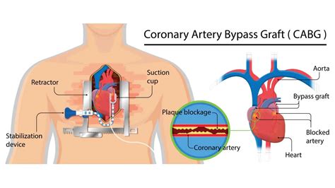 Coronary Artery Bypass Grafting (CABG) - Heart Bypass Surgery