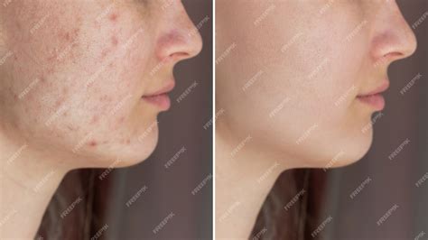 Premium Photo | Cropped shot of young womans face before and after acne ...