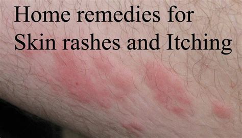 Identifying Skin Rashes In Adults