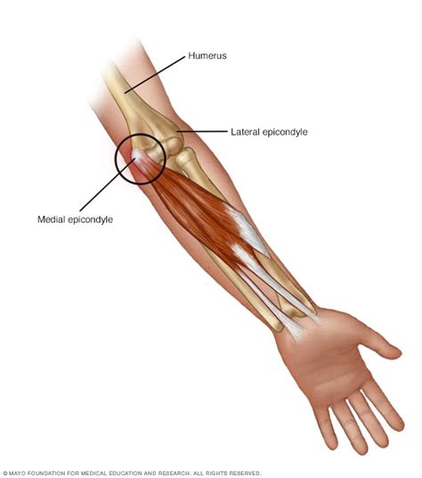 Golfer's elbow - Mayo Clinic