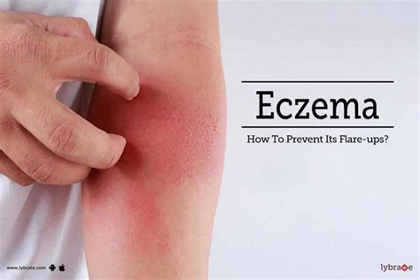 Eczema - How To Prevent Its Flare-ups? - By Dr. Nimesh D Mehta | Lybrate