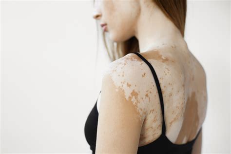 Vitiligo: More than skin deep - Harvard Health