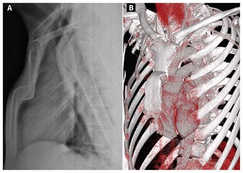 Stairlike fracture of the sternum | CMAJ