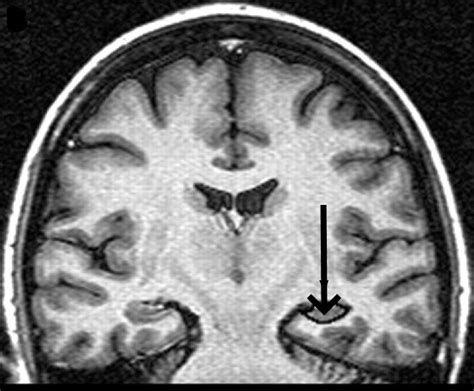 Brain atrophy - Neuromedia