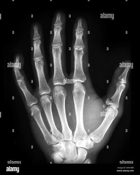 Thumb Proximal Phalanx Fracture