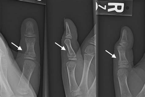 Thumb Proximal Phalanx Fracture