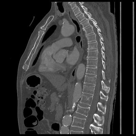 Sagittal Ct Thorax Anatomy