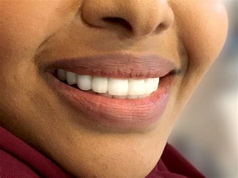 Bright Smile – Teeth Whitening - Malaysia Cosmetic Dentist