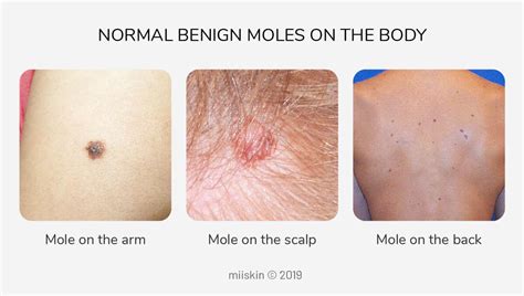 About Moles - Types, Warning Signs, Causes, and Prevention