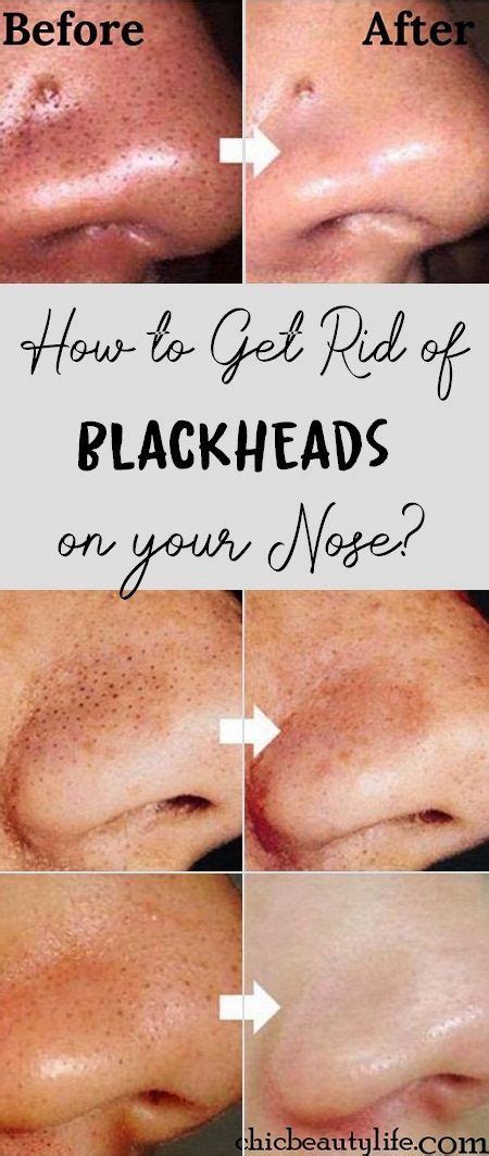 How to Get Rid of Blackheads on your Nose? | Blackheads on nose, Get ...