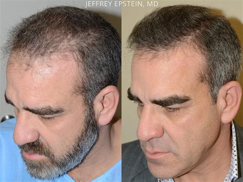 Hair Transplants for Men photos | Miami, FL | Patient54176