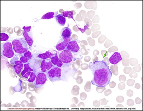 Immunoblastic morphological variant - CELL - Atlas of Haematological ...