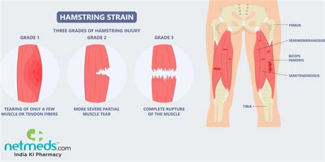 Leg Muscles Diagram Hamstring : Thigh Muscle Strains Florida ...