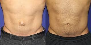 Pin on Our best Umbilical Hernia repair surgery