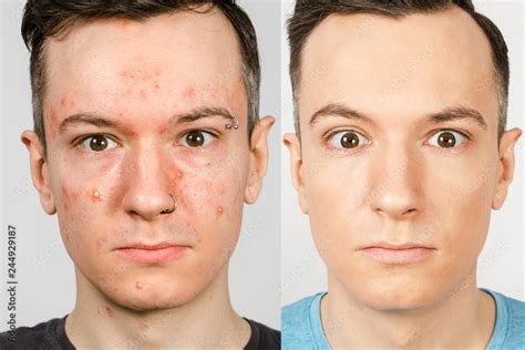 two guys before-after: left guy with acne, red spots, problem skin ...