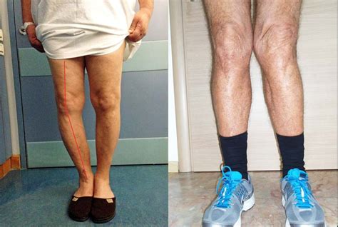 Knee Osteoarthritis - An Overview - Robert Howells