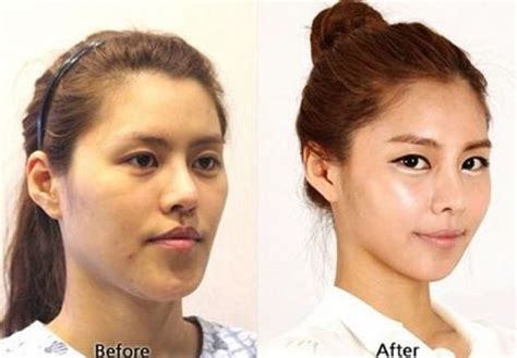 These Amazing Transformation After Their Plastic Surgery Will Blow Your ...