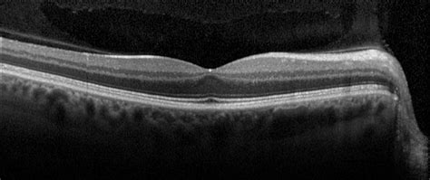 Optical Coherence Tomography | Department of Ophthalmology and Visual ...