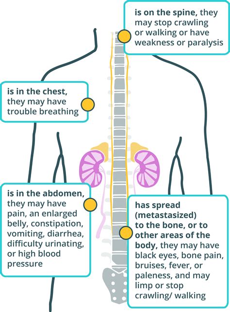 What is Neuroblastoma | Causes & Symptoms