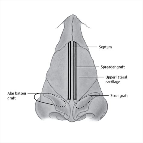 A Patient With Nasal Valve Compromise | Facial Plastic Surgery | JAMA ...