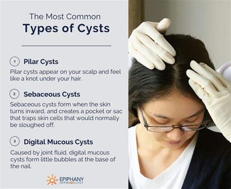 Cyst Removal | Cyst Treatment | Sebaceous Cyst Removal