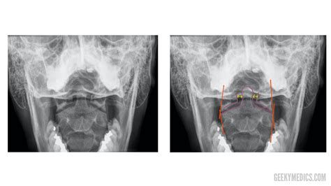 Cervical Spine X-ray Interpretation - OSCE Guide | Geeky Medics