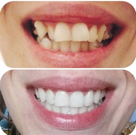 Beautiful before and after. Free teeth whitening with every Invisalign ...