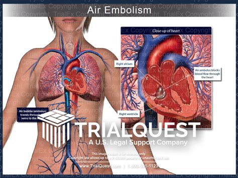 Air Embolism - TrialExhibits Inc.