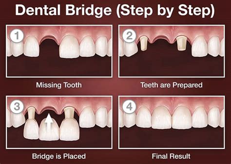 The Pros and Cons of a Dental Bridge | Dentist For Life