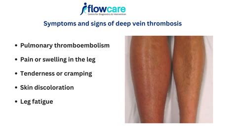 Symptoms and signs of deep vein thrombosis | Treatment