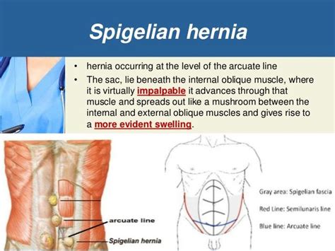 Pin on hernias- groin