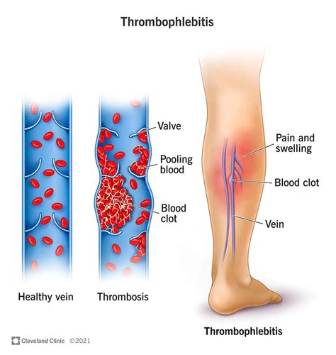 Superficial Venous Thrombosis