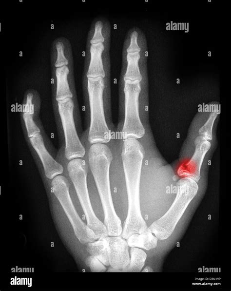 Distal Phalanx Fracture