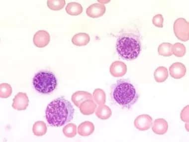 Hairy Cell Leukemia: Practice Essentials, Pathophysiology, Epidemiology