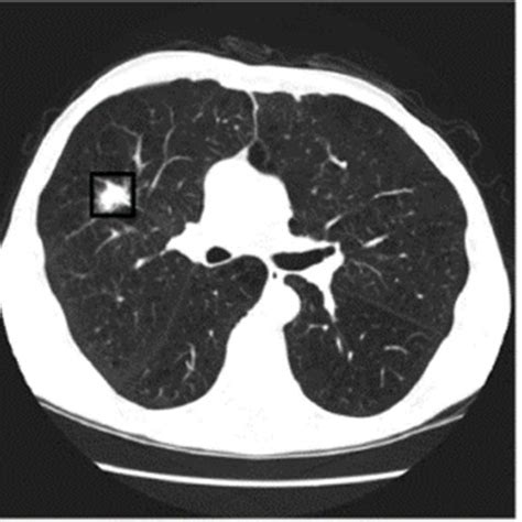 Categories of lung nodules in a CT scan; benign, primary malignant, and ...