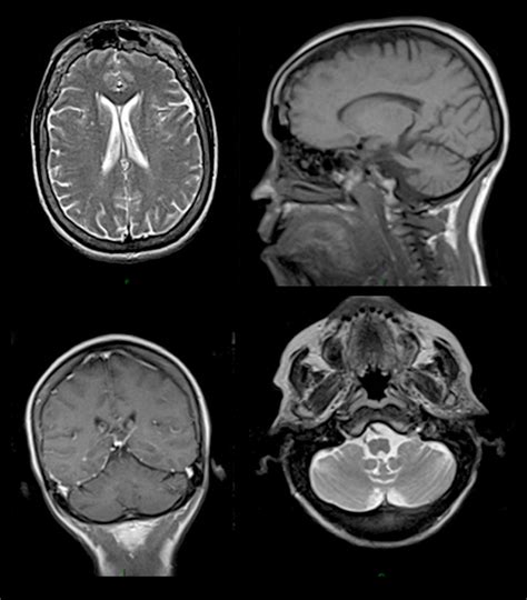 Female Normal MRI Brain