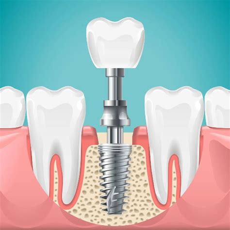 Premier Dental Implants Clinic In Hyderabad & Bangalore