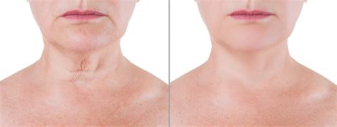 Botox for Neck | New Skin Laser Center